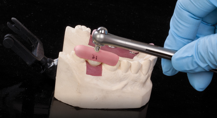 Трансфер чек. Абатмент чек в стоматологии. Что такое трансфер чеки в стоматологии.